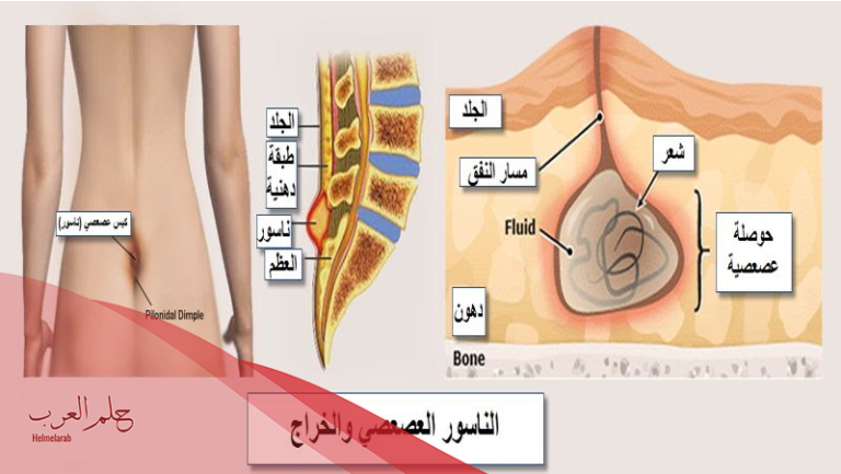 علاج الناسور بالمره وهل يعالج الناسور بالفعل