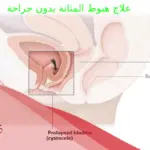 علاج هبوط المثانة بدون جراحة