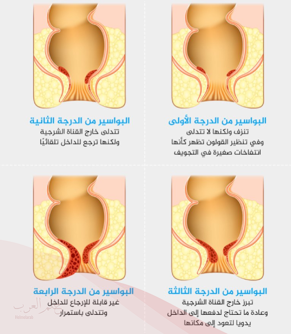 هل دكتور المسالك البولية يعالج البواسير