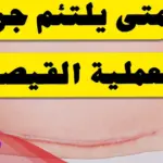 متى يلتئم جرح العملية القيصرية الداخلي