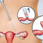 مين جربت فتح ربط عنق الرحم وهل هو مؤلم؟