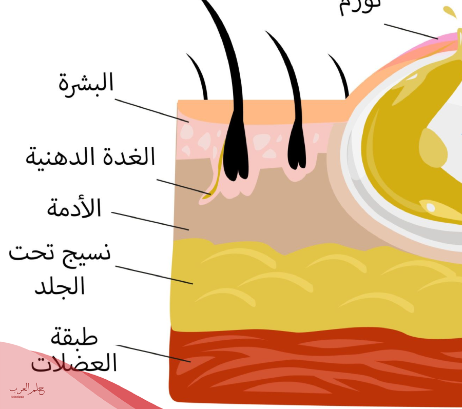تجربتي مع الكيس الدهني في الظهر وهل هو خطير؟