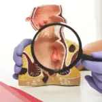 هل دكتور المسالك البولية يعالج البواسير