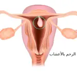 طريقة إزالة لحمية الرحم بالأعشاب