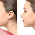 تجربتي مع يزيد الغنيم في تجميل الانف