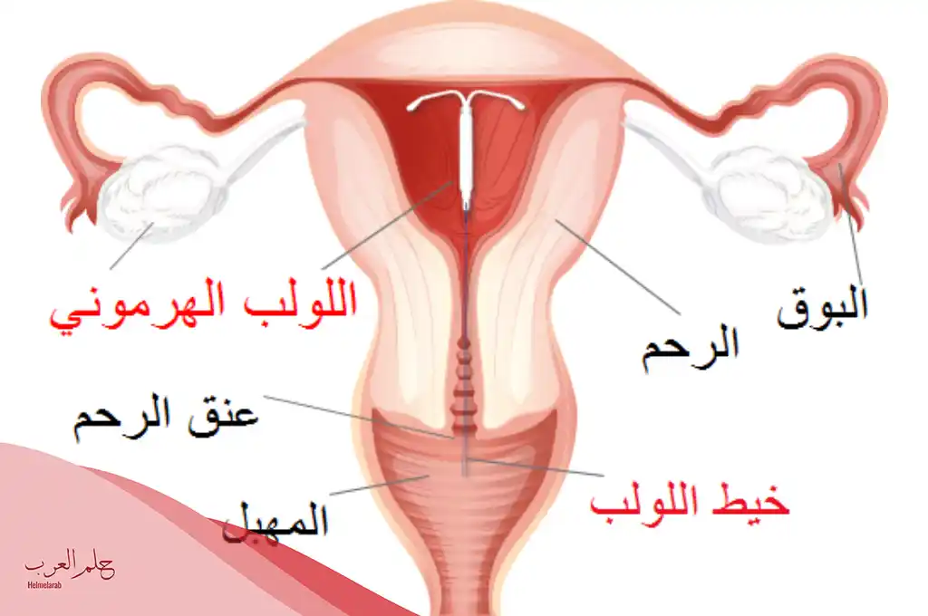 العلاقة بين اللولب الهرموني وزيادة الوزن
