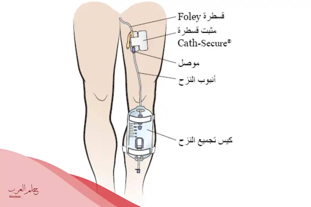 هل تركيب القسطرة البولية مؤلم