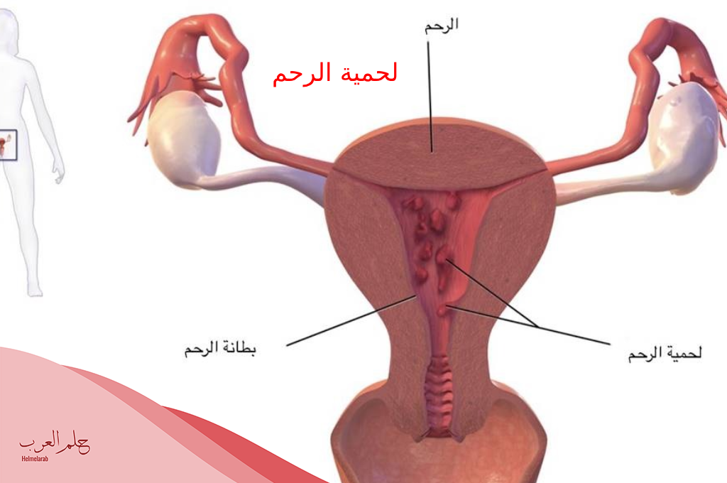 طريقة إزالة لحمية الرحم بالأعشاب