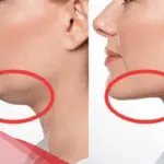 متى تظهر نتائج الهايفو على الوجه