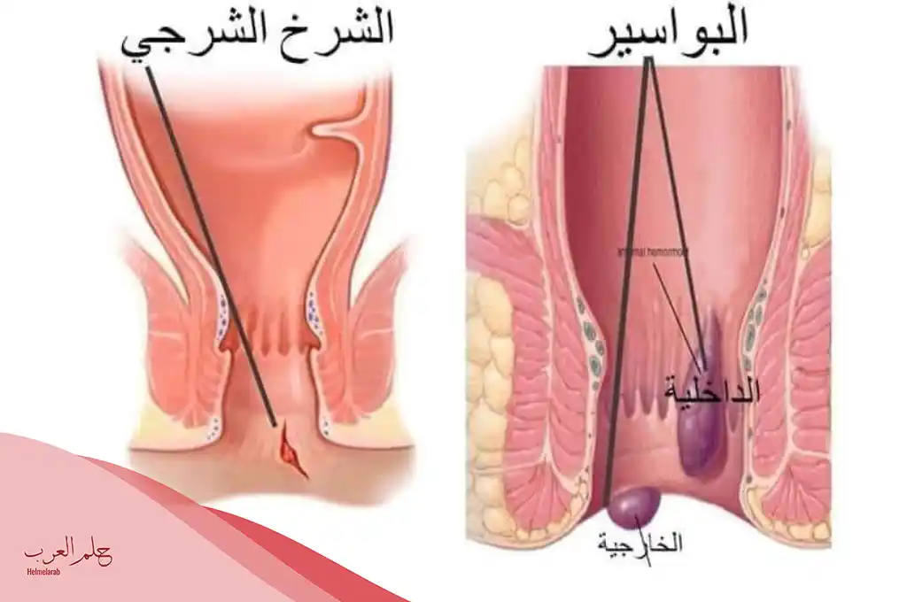 علاج سريع المفعول للشرخ بالاعشاب