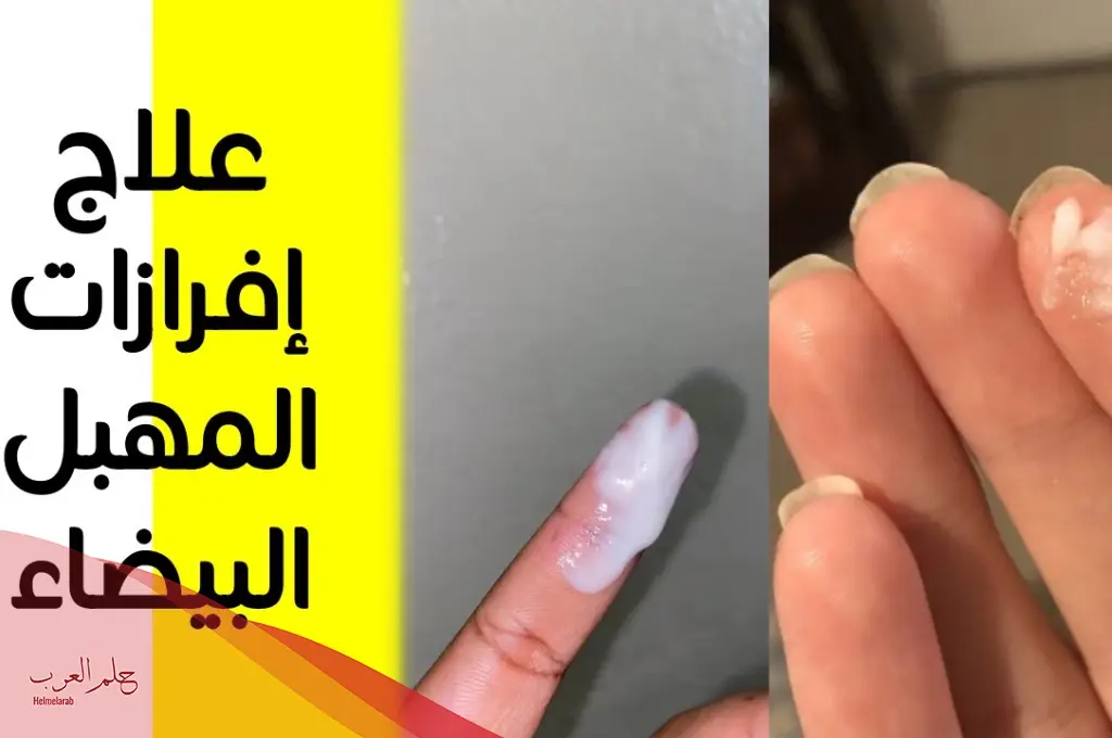 أسباب خروج مادة بيضاء متكتله من المهبل