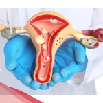 علاج هبوط الرحم في الطب النبوي