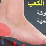 تجربتي مع الشوكة العظمية 
