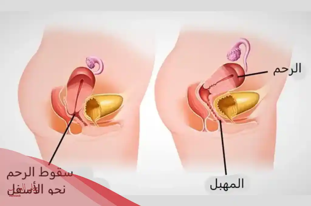 علاج هبوط الرحم في الطب النبوي