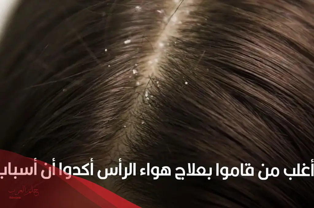علاج هواء الراس بزيت الزيتون والاعشاب مجرب