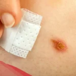 هل قرحة الفراش تسبب الوفاة