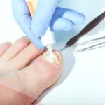 أشهر اسم 3 مراهم لعلاج الفطريات بين الفخذين