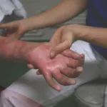 هل من الأفضل تغطية الحروق؟