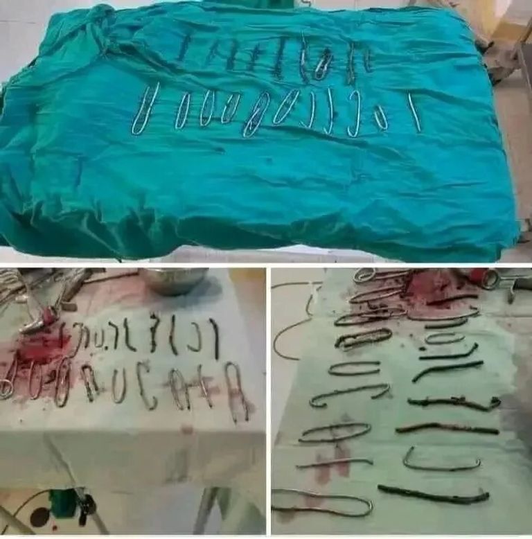بعد جراحة معقدة.. نجاح الأطباء في استخراج 20 مسمارًا وأسلاك معدنية من بطن مريض بعد جراحة معقدة.. نجاح الأطباء في استخراج 20 مسمارًا وأسلاك معدنية من بطن مريض