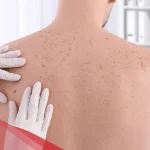 سبب ظهور بقع سوداء على الجلد مع حكه وطرق علاجة