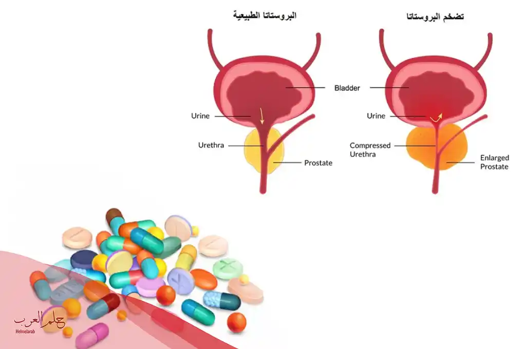 افضل مضاد حيوي لعلاج التهاب البروستاتا