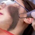 متى تظهر نتائج الليزر الكربوني