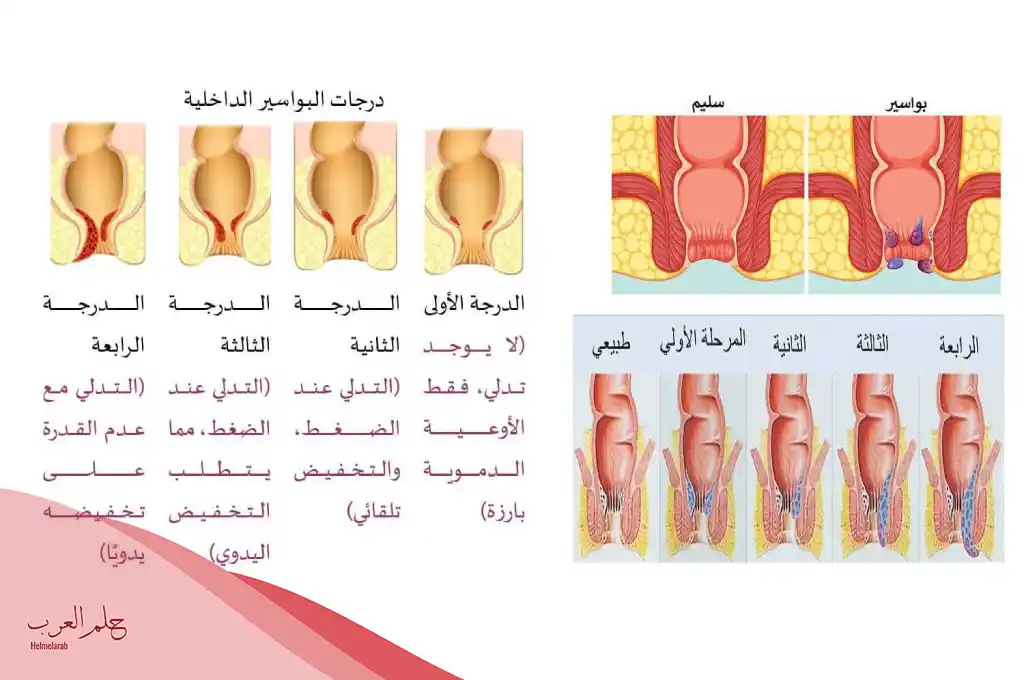وصفة للتخلص من البواسير في دقيقتين
