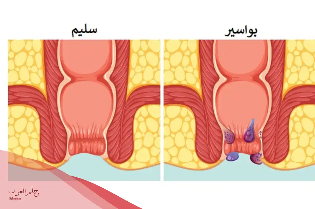اعراض توسيع المخرج بعد عملية البواسير