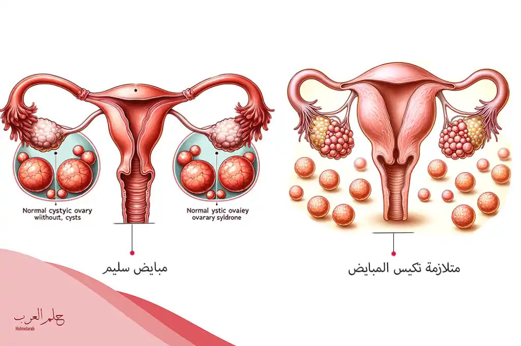 من قالوا لها كيس ع المبيض وطلع حمل