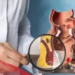 وصفة للتخلص من البواسير في دقيقتين