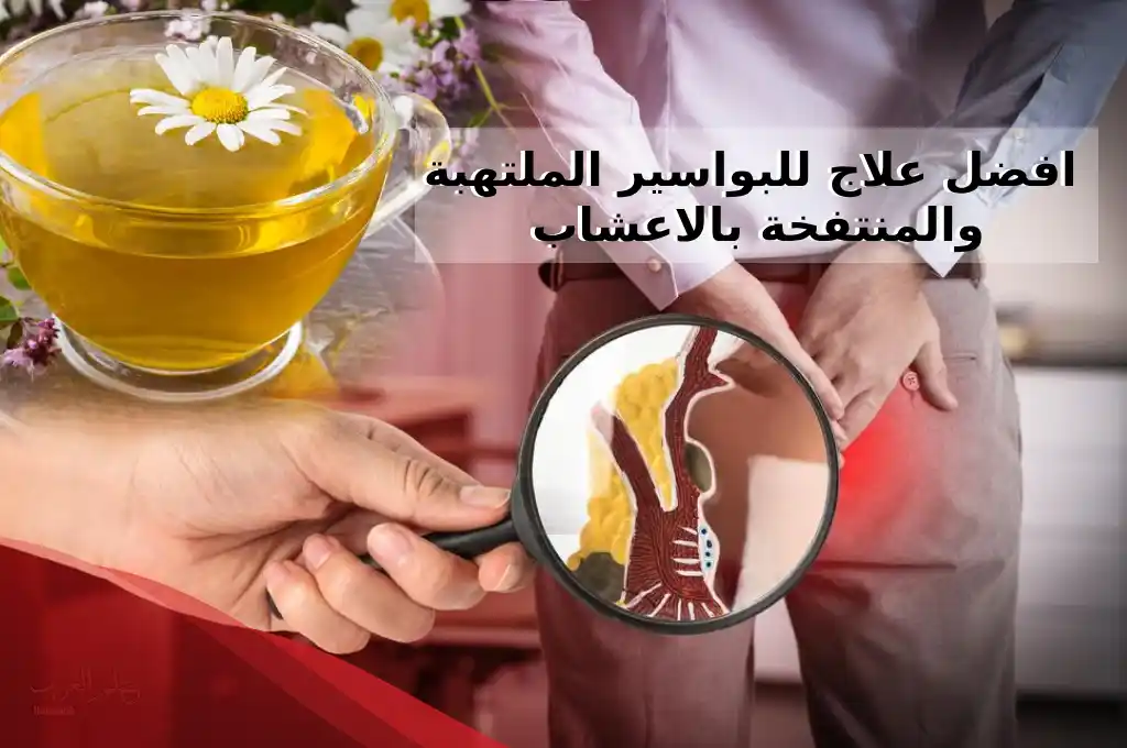 افضل علاج للبواسير الملتهبه والمنتفخة بالاعشاب