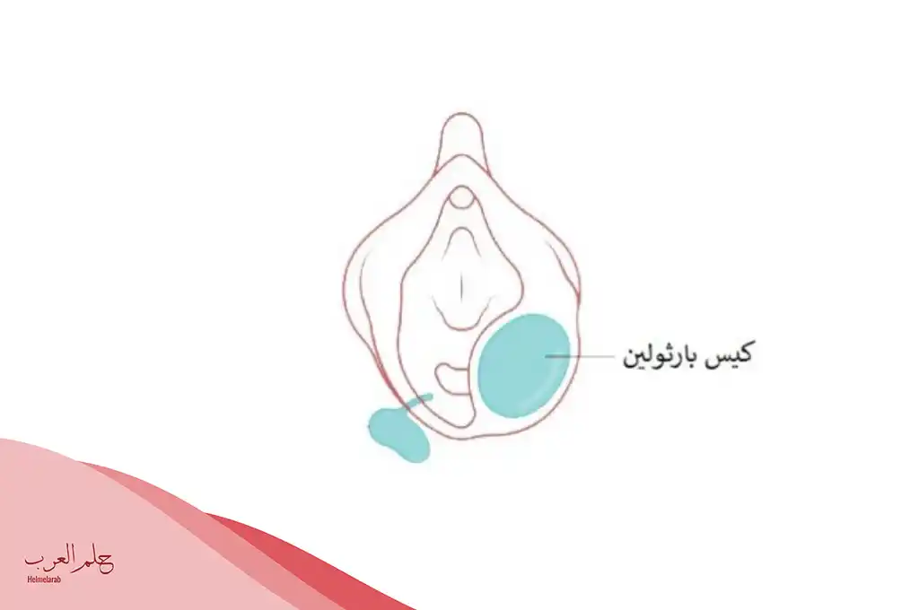 افضل مضاد حيوي لالتهاب غدة بارثولين