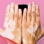 أهم 7 فروق بين البهاق والفطريات بالصور