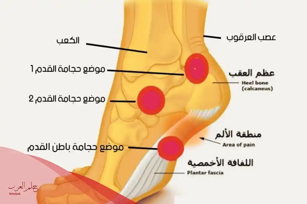 علاج التهاب اللفافة الاخمصية بالحجامة